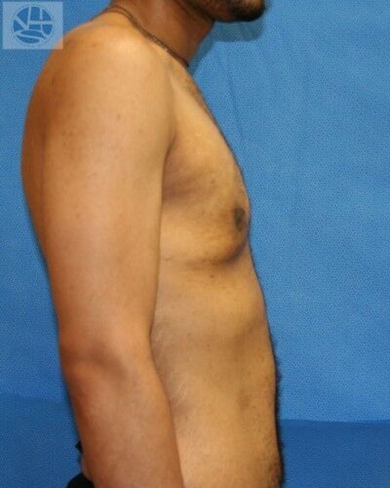 Gynecomastia Before & After Gallery - Patient 55345285 - Image 4