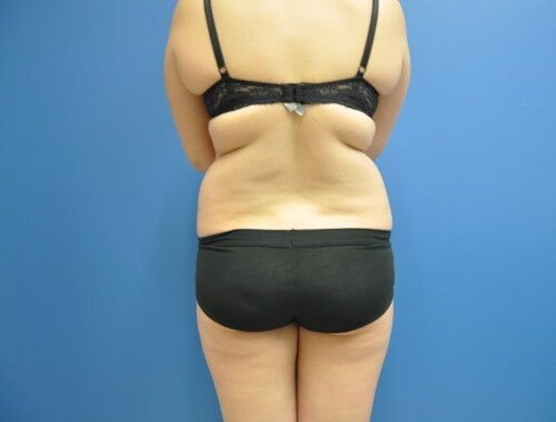 Liposuction Before & After Gallery - Patient 211876590 - Image 5