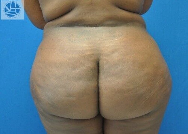 Brazilian Butt Lift Before & After Gallery - Patient 55345288 - Image 4