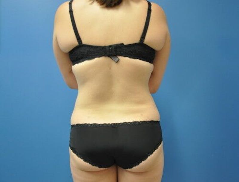 Liposuction Before & After Gallery - Patient 211876590 - Image 6