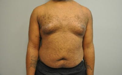 Gynecomastia Before & After Gallery - Patient 55345291 - Image 1