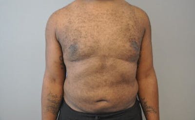 Gynecomastia Before & After Gallery - Patient 55345291 - Image 2