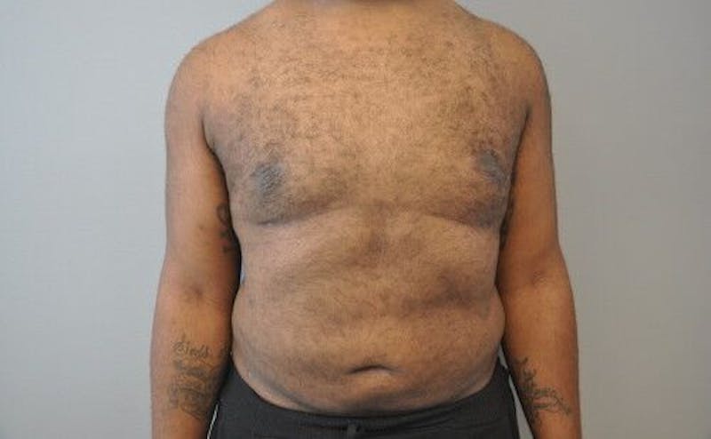 Gynecomastia Before & After Gallery - Patient 55345291 - Image 2