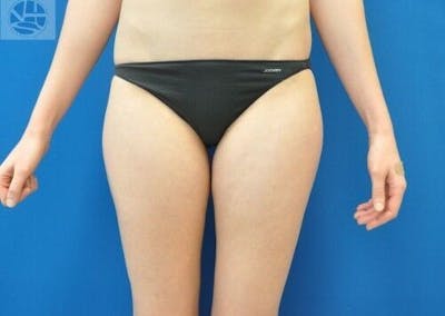 Liposuction Gallery - Patient 55345290 - Image 1