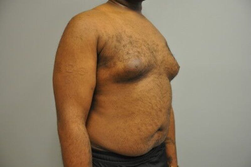 Gynecomastia Before & After Gallery - Patient 55345291 - Image 3