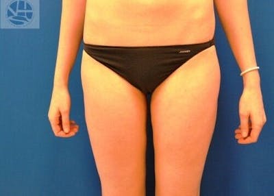 Liposuction Gallery - Patient 55345290 - Image 2