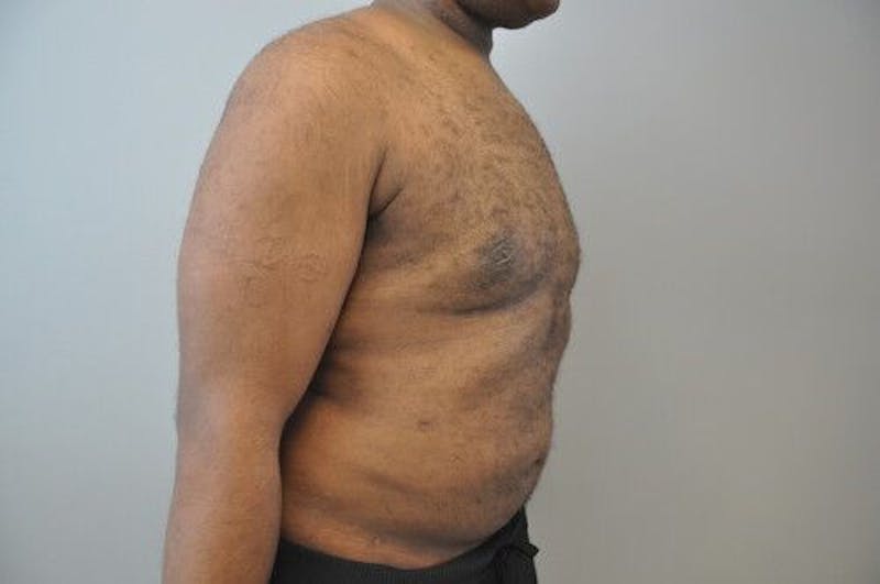 Gynecomastia Before & After Gallery - Patient 55345291 - Image 4