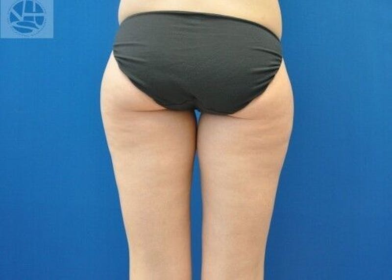 Liposuction Before & After Gallery - Patient 211876609 - Image 3