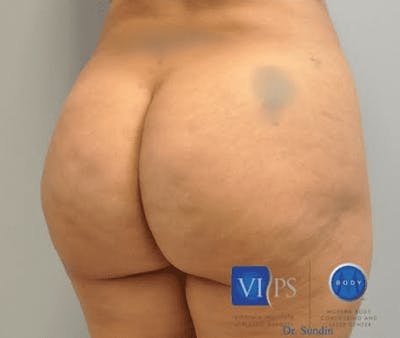 Brazilian Butt Lift Gallery - Patient 55345289 - Image 2