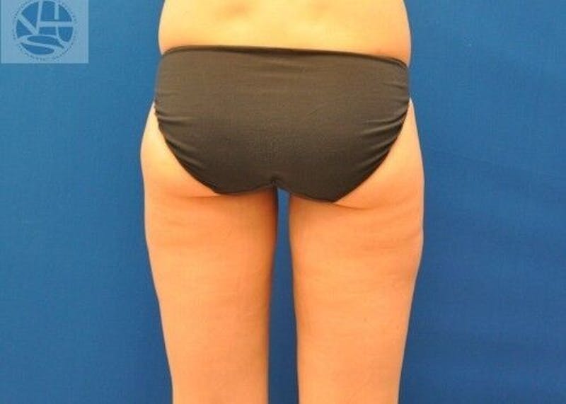 Liposuction Before & After Gallery - Patient 211876609 - Image 4
