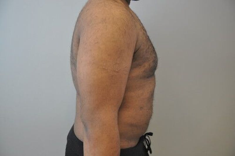 Gynecomastia Before & After Gallery - Patient 55345291 - Image 6