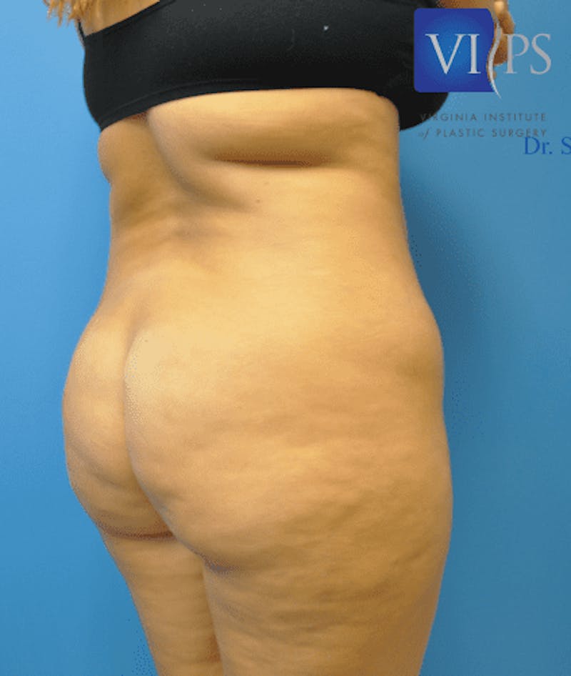 Brazilian Butt Lift Before & After Gallery - Patient 55345310 - Image 1