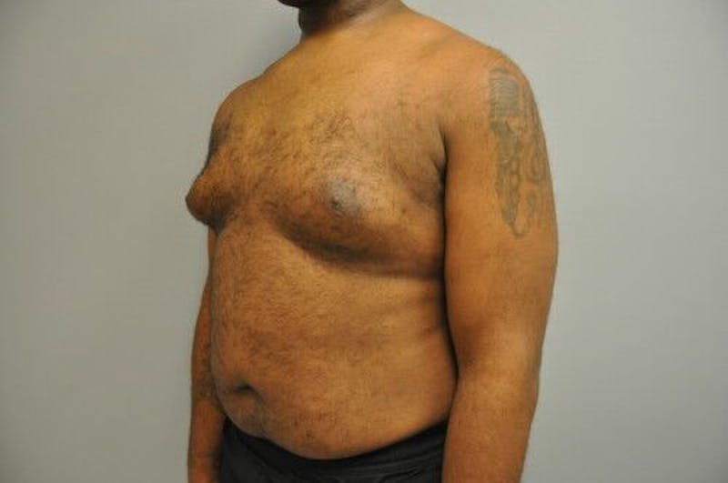 Gynecomastia Before & After Gallery - Patient 55345291 - Image 7