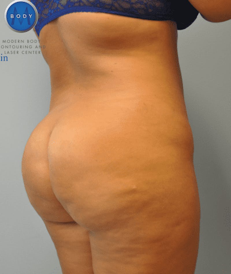 Brazilian Butt Lift Before & After Gallery - Patient 55345310 - Image 2