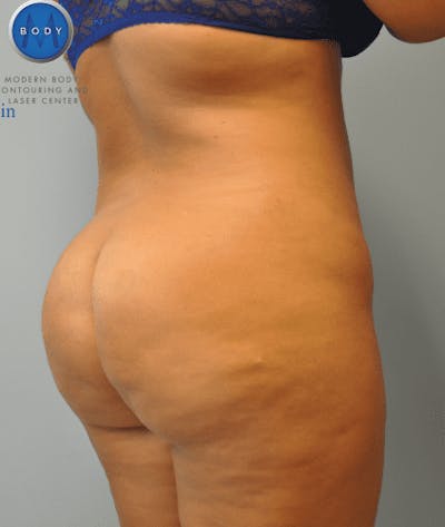 Brazilian Butt Lift Gallery - Patient 55345310 - Image 2