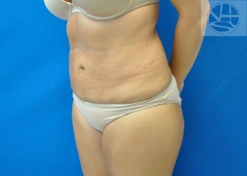 Liposuction Before & After Gallery - Patient 211876587 - Image 2