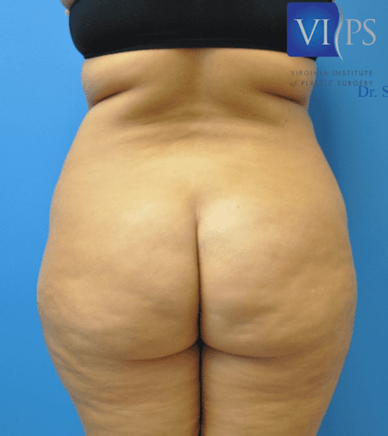 Brazilian Butt Lift Before & After Gallery - Patient 55345310 - Image 3