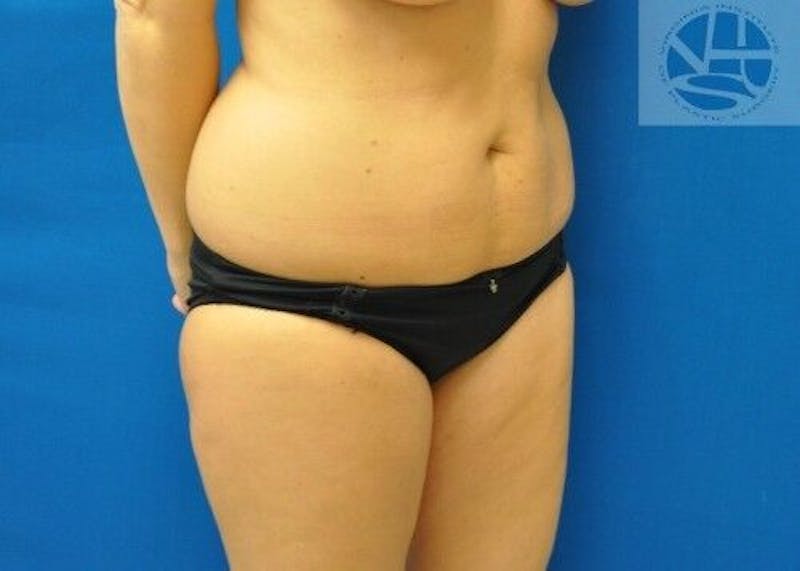 Liposuction Before & After Gallery - Patient 211876587 - Image 3