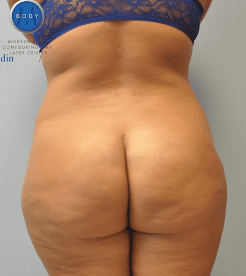Brazilian Butt Lift Before & After Gallery - Patient 55345310 - Image 4
