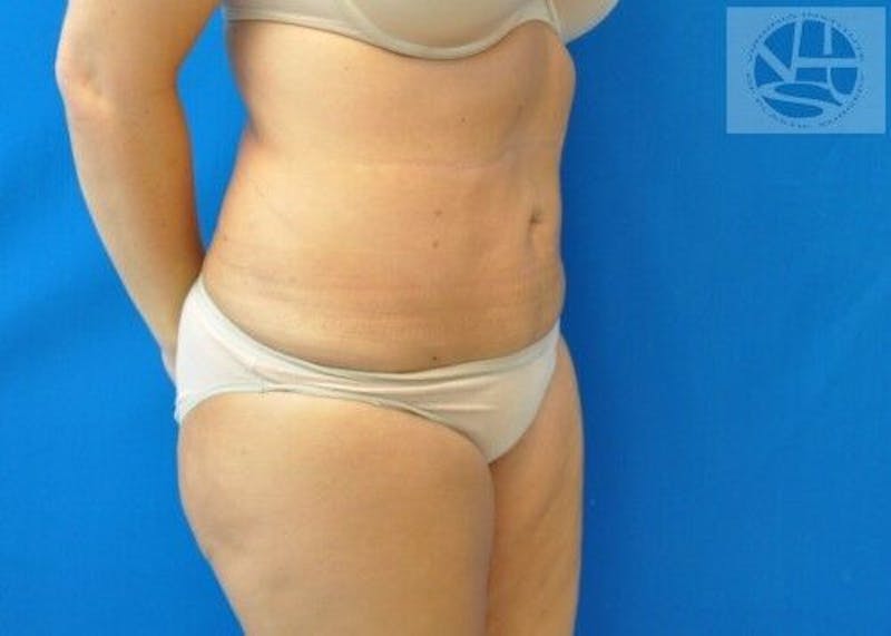 Liposuction Gallery - Patient 55345305 - Image 4