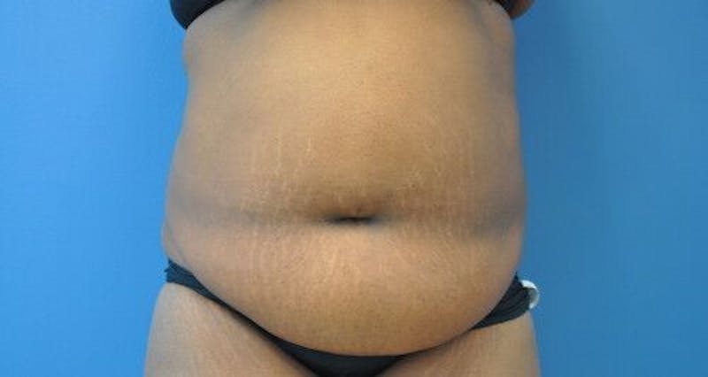 Tummy Tuck Before & After Gallery - Patient 55345307 - Image 1