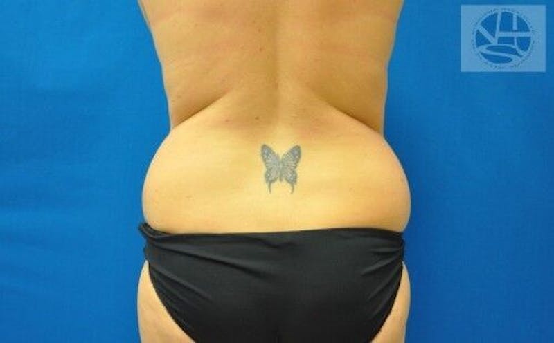 Liposuction Before & After Gallery - Patient 211876587 - Image 5