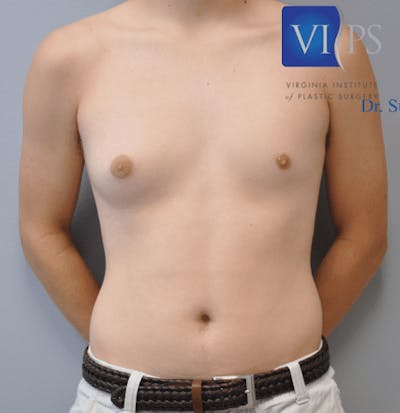 Gynecomastia Before & After Gallery - Patient 55345306 - Image 1