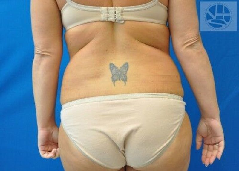 Liposuction Gallery - Patient 55345305 - Image 6