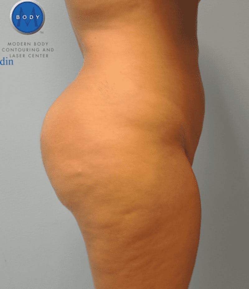 Brazilian Butt Lift Gallery - Patient 55345310 - Image 6