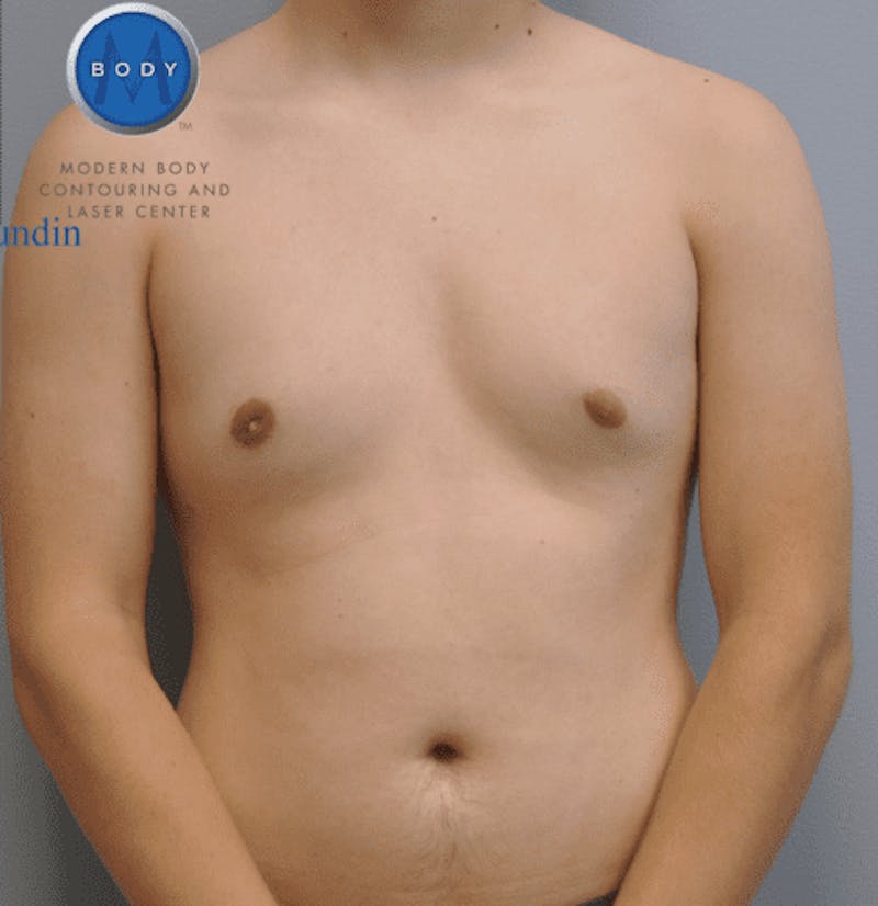 Gynecomastia Before & After Gallery - Patient 55345306 - Image 2