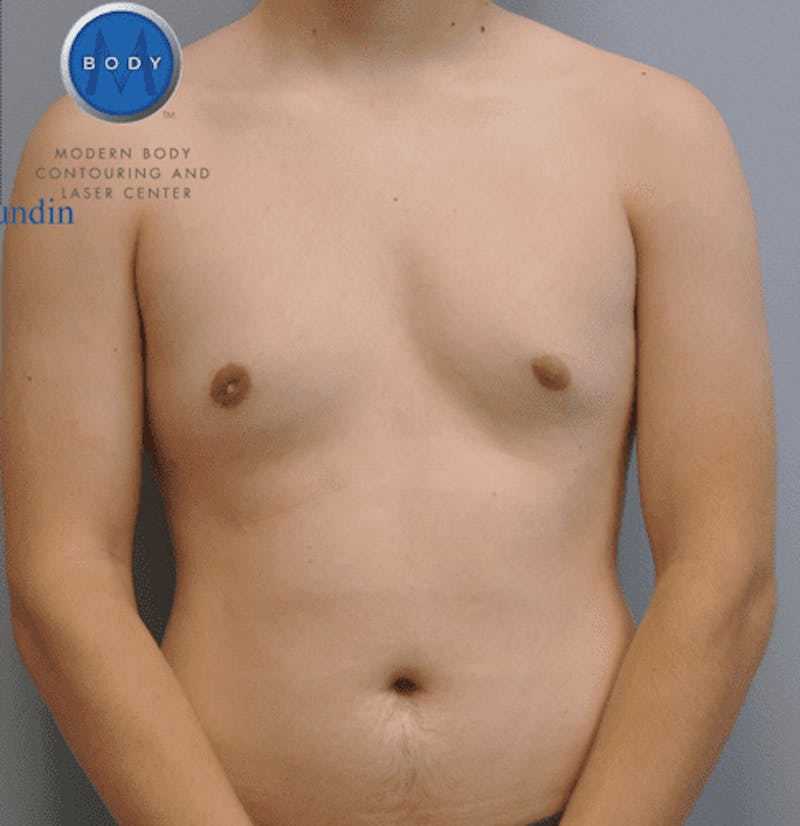 Gynecomastia Before & After Gallery - Patient 55345306 - Image 2