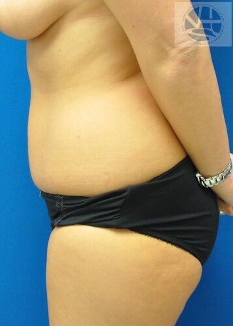 Liposuction Before & After Gallery - Patient 211876587 - Image 7