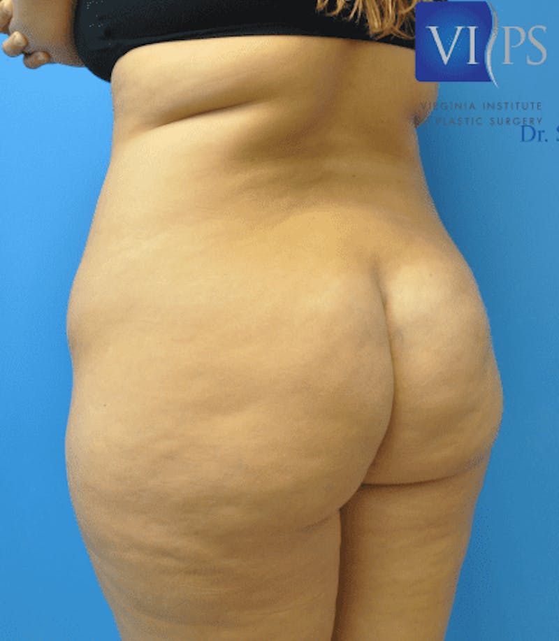 Brazilian Butt Lift Before & After Gallery - Patient 55345310 - Image 7