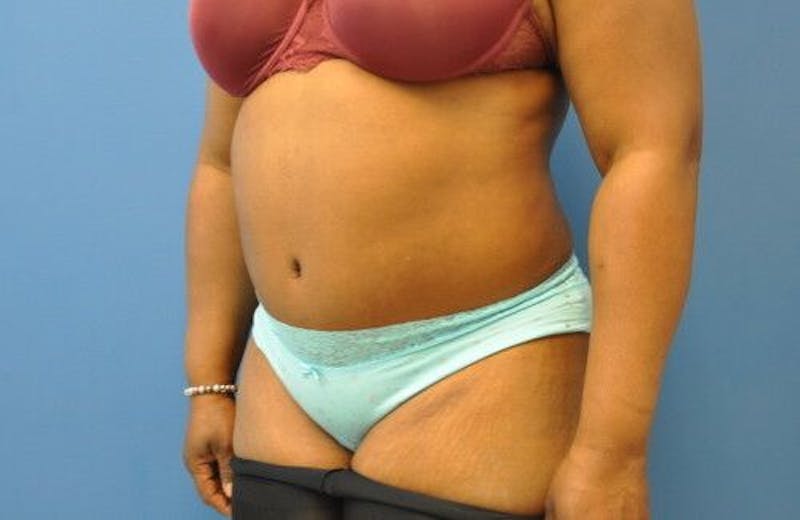 Tummy Tuck Before & After Gallery - Patient 55345307 - Image 4