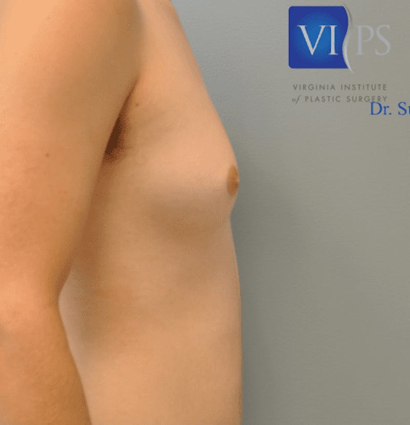 Gynecomastia Before & After Gallery - Patient 55345306 - Image 3