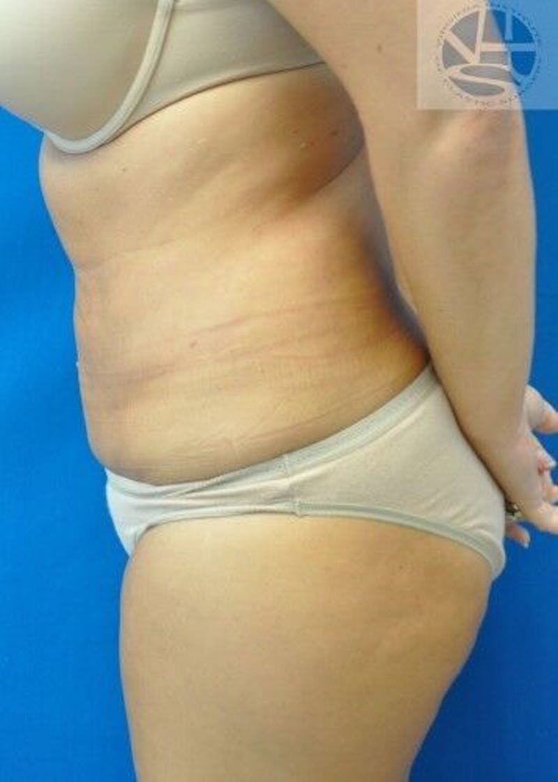 Liposuction Before & After Gallery - Patient 55345305 - Image 8