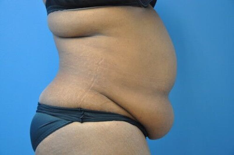 Tummy Tuck Before & After Gallery - Patient 55345307 - Image 5
