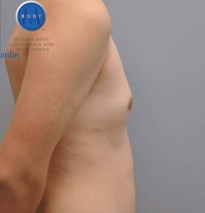 Gynecomastia Before & After Gallery - Patient 55345306 - Image 4
