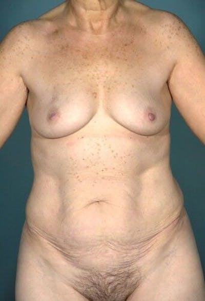 Mommy Makeover Gallery - Patient 55345308 - Image 1