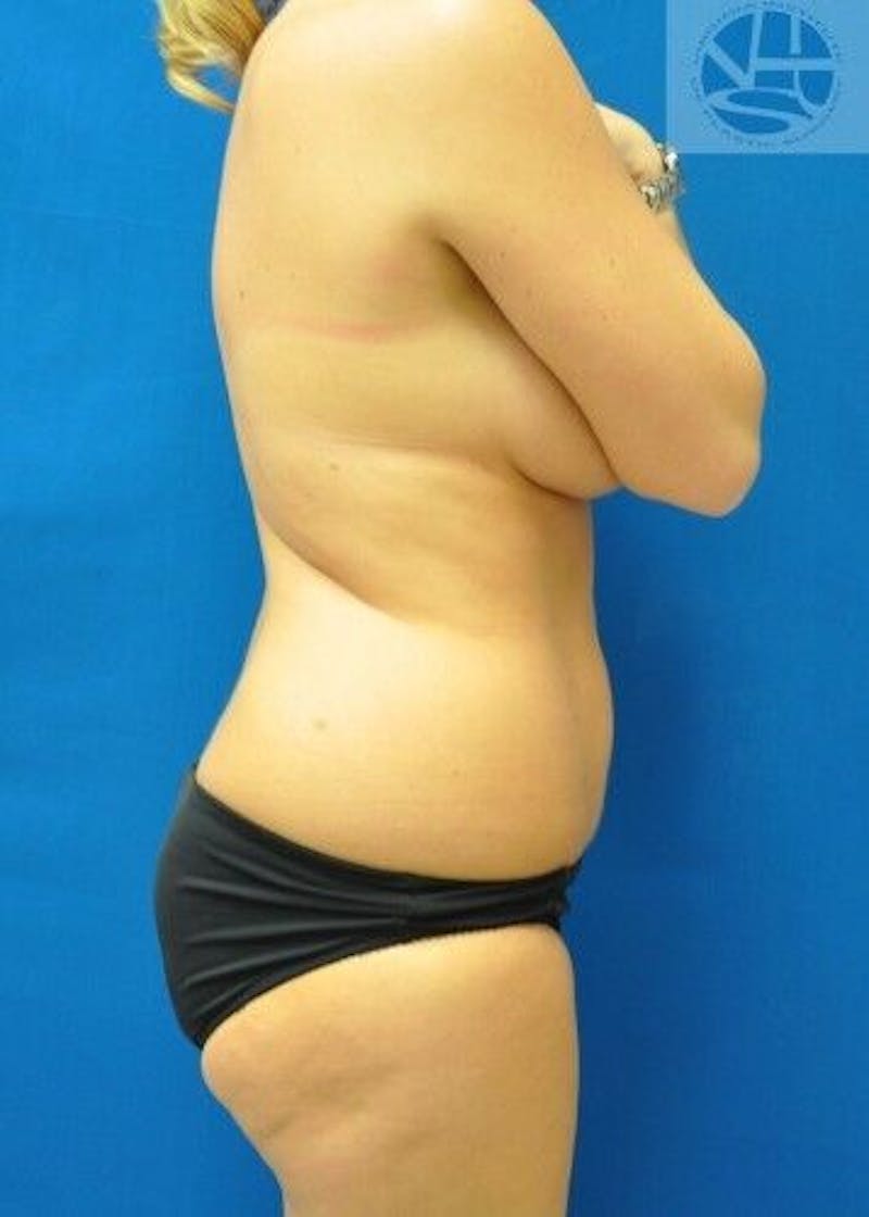 Liposuction Before & After Gallery - Patient 55345305 - Image 9