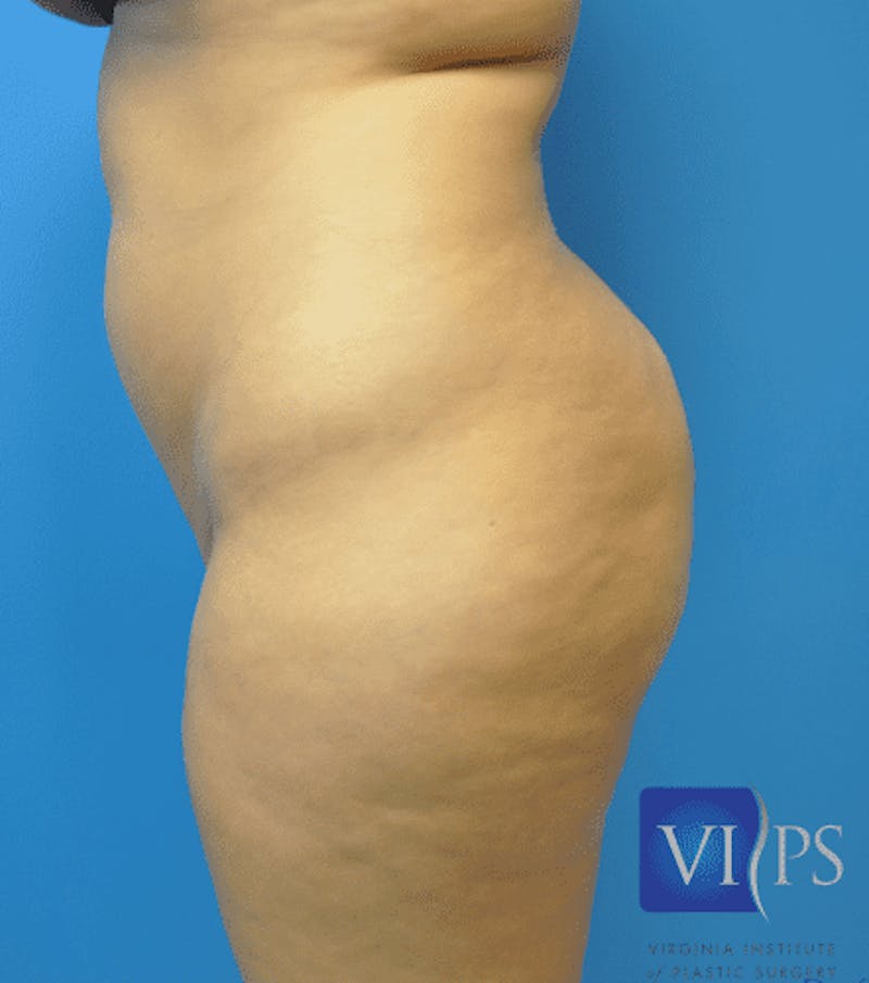 Brazilian Butt Lift Before & After Gallery - Patient 55345310 - Image 9