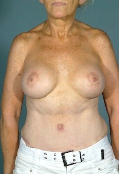 Mommy Makeover Before & After Gallery - Patient 55345308 - Image 2