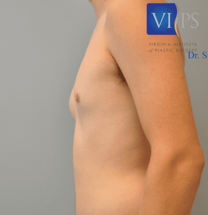Gynecomastia Before & After Gallery - Patient 55345306 - Image 5