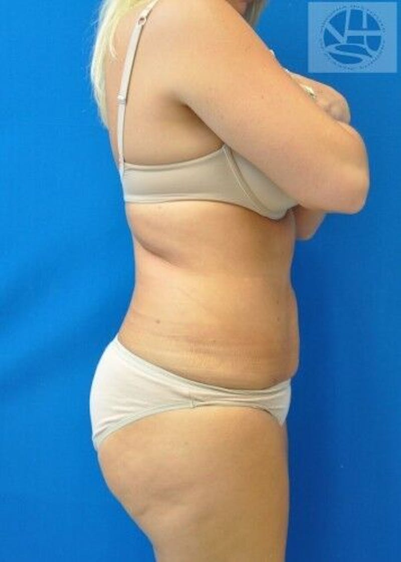 Liposuction Before & After Gallery - Patient 211876587 - Image 10