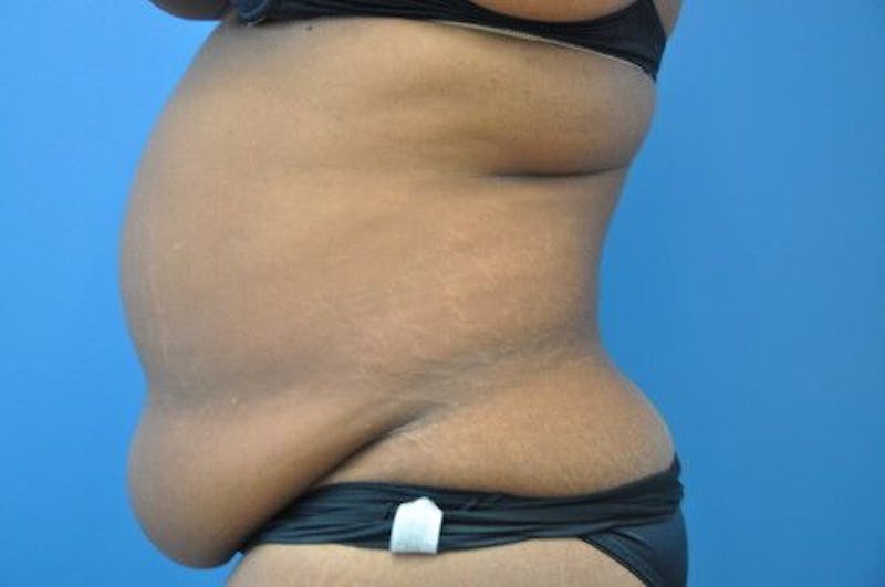 Tummy Tuck Before & After Gallery - Patient 55345307 - Image 7