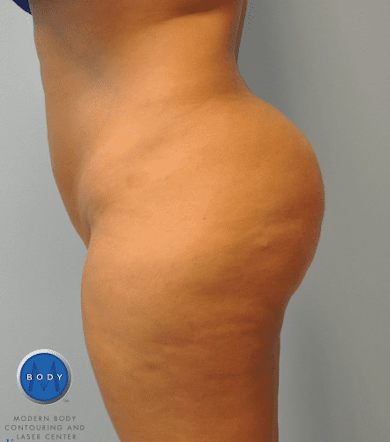 Brazilian Butt Lift Before & After Gallery - Patient 55345310 - Image 10