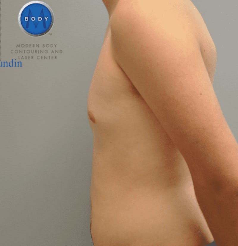 Gynecomastia Before & After Gallery - Patient 55345306 - Image 6