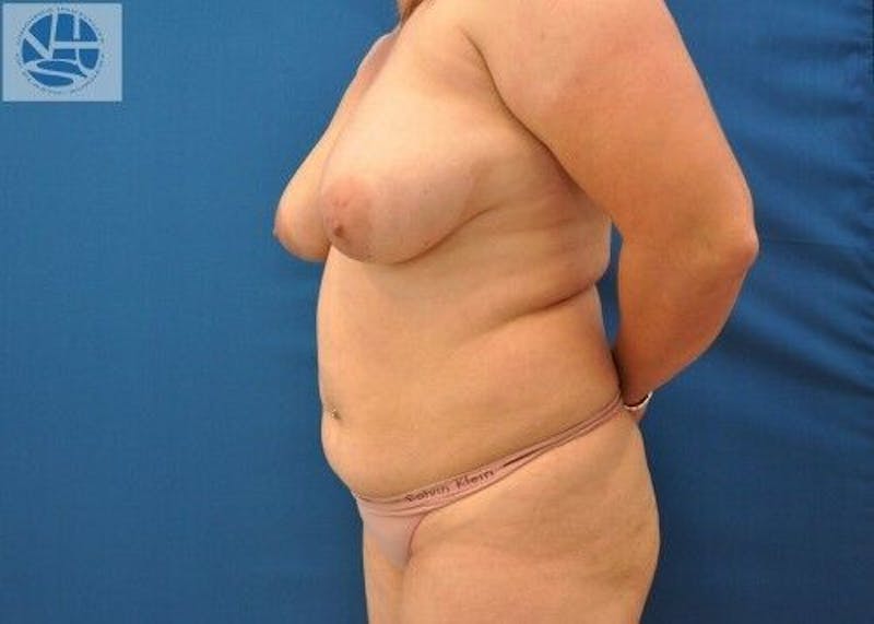 Liposuction Before & After Gallery - Patient 55345313 - Image 1