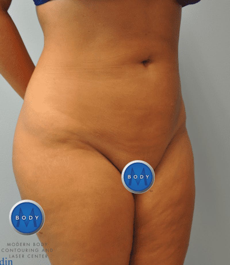 Brazilian Butt Lift Gallery - Patient 55345310 - Image 12
