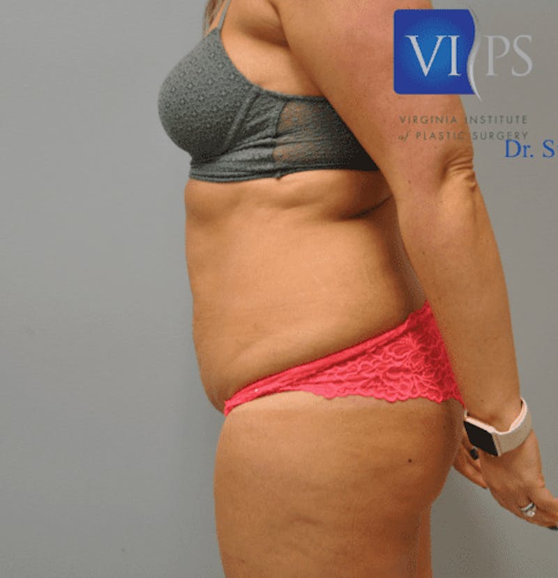 Tummy Tuck Before & After Gallery - Patient 55345309 - Image 3